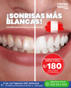 blanqueamiento dental callao
