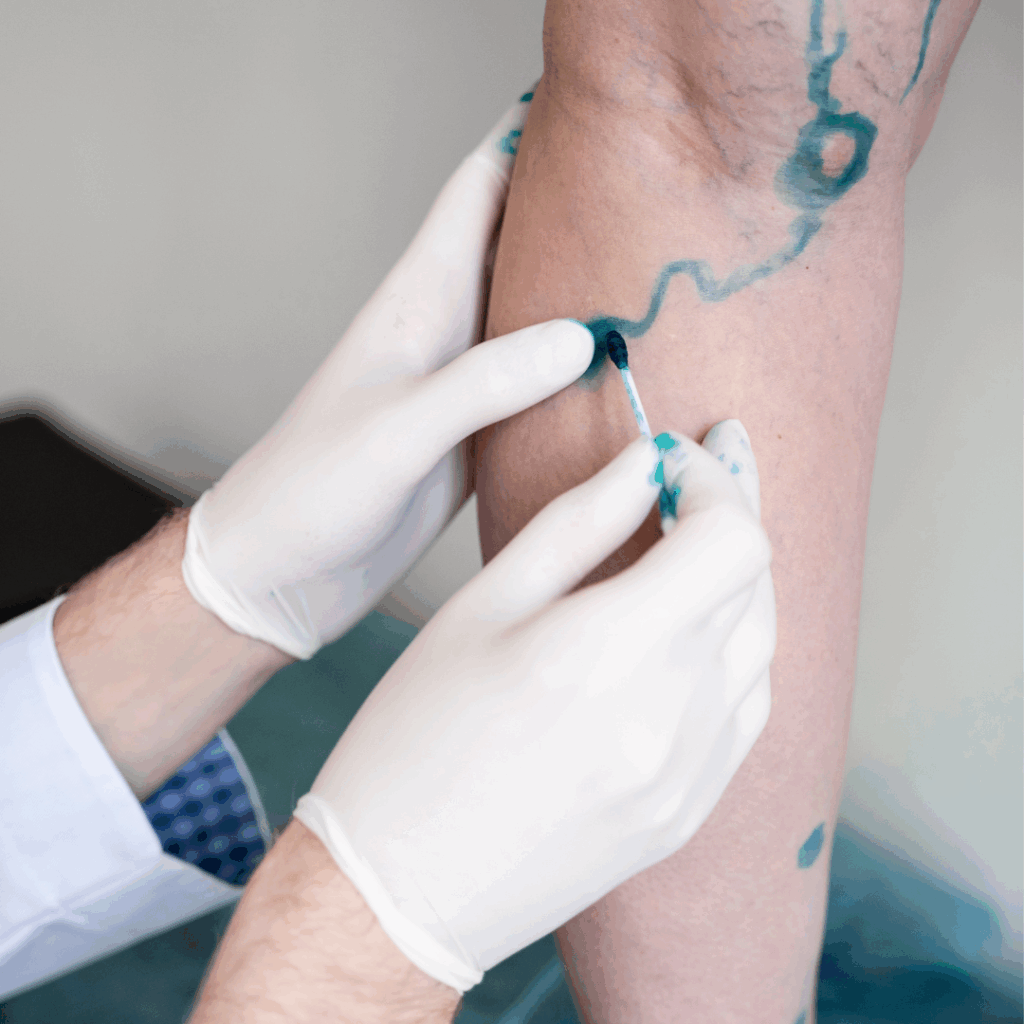 escleroterapia cmc 2